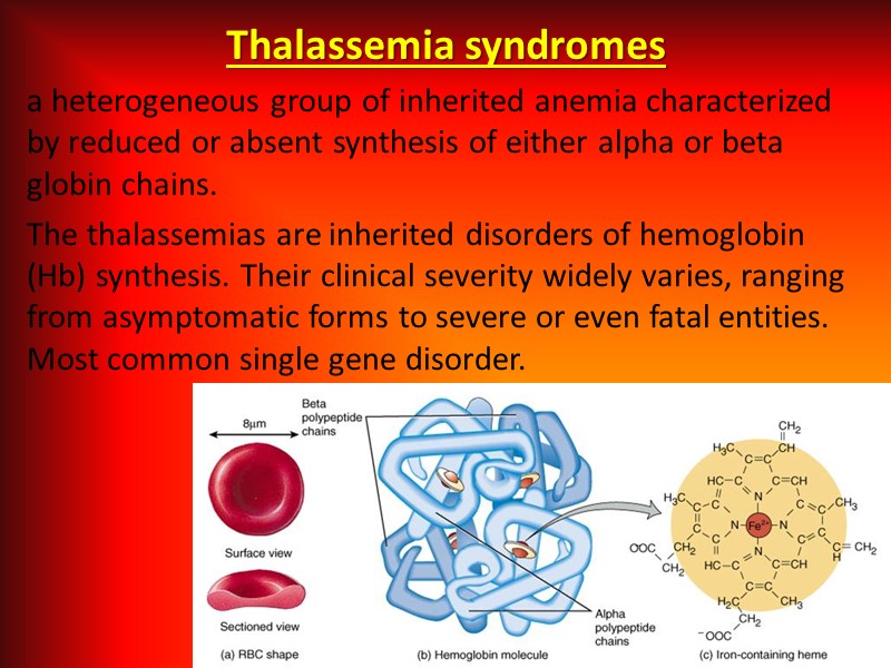 Thalassemia syndromes a heterogeneous group of inherited anemia characterized by reduced or absent synthesis
